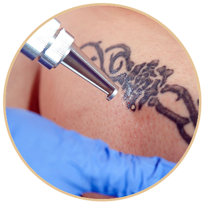 Remoção de Tatuagem e Micropigmentação
